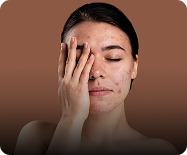Hyperpigmented skin